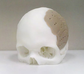 3D打印颅骨有望投入临床治疗