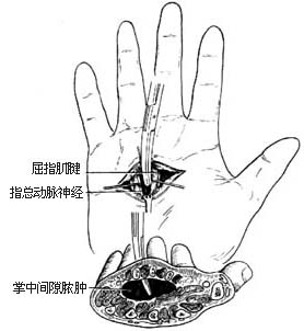 掌中间隙脓肿切开引流术