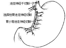 选择性胃迷走神经切断术