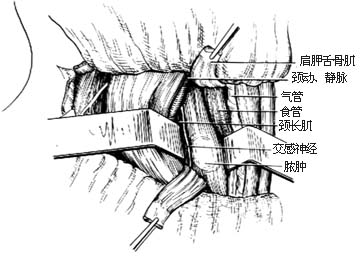经颈结核病灶清除术