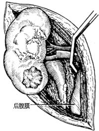 肾部分切除术