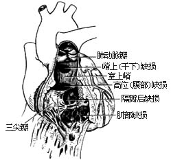室间隔缺损修补术
