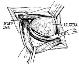 腹股沟直疝修复术
