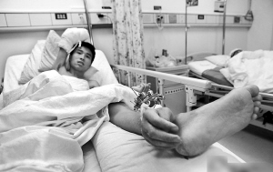 断手“寄养”于小腿 一个月后成功回植