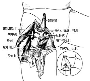 髋关节离断术