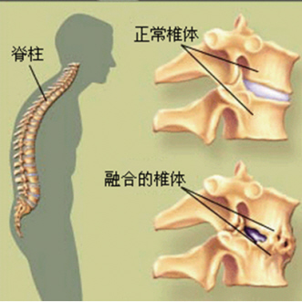 中医防治“不死的癌症”