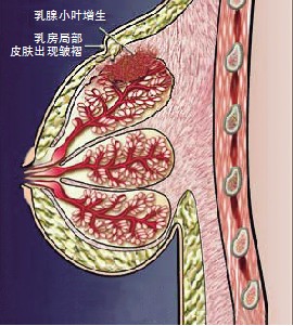 乳腺癌筛查须趁早