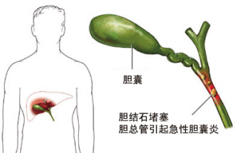 胆囊炎发作咋诊治