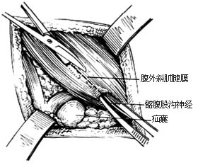 经腹股沟股疝修复术
