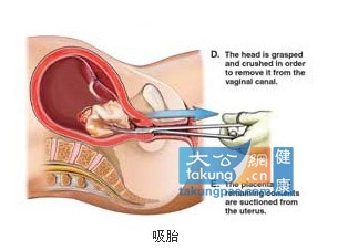 实拍堕胎手术全过程 呼吁珍惜生命