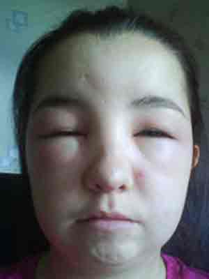 绝美少女用染发剂后毁容 头部肿到两倍大
