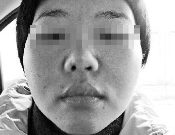 打工妹做隆鼻手术后鼻孔一大一小