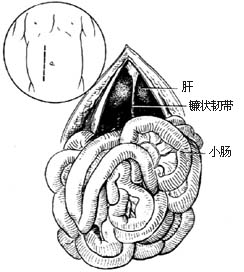 先天性肠旋转不全整复术