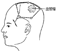 脑血管畸形手术