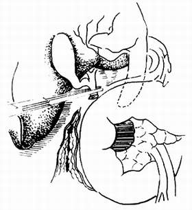 胰腺癌（肝胆外科）