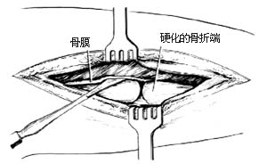 骨折不愈合、骨缺损骨移植术