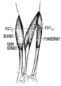代前臂伸肌手术