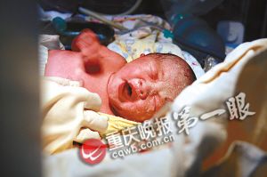 准妈妈怀孕两月被查出囊肿 冒险坚持终产健康宝宝