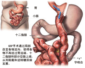 解析GBP手术治疗T2DM
