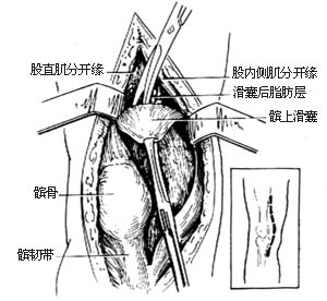 膝关节结核病灶清除术