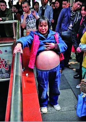 女子患怪病肚子越涨越大 为不拖累家人剖腹