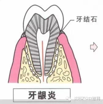 牙龈炎处理不当或成牙周炎