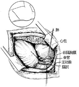经胸食管下段和胃底曲张静脉缝扎术