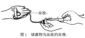 输液堵塞处理技巧