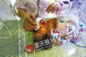四川遂宁双头女婴家长质疑医院孕期未发现畸形