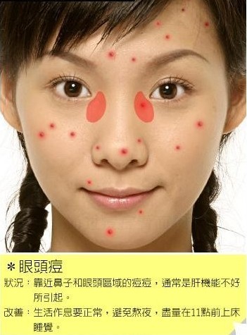 通过脸上痘痘位置看你的健康状况