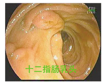 十二指肠降段：进退之间巧观察