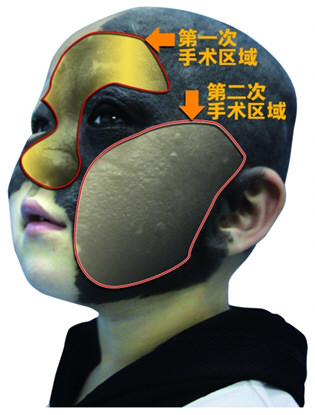 龙凤胎弟弟皮肤白皙 姐姐黑痣占大半张脸