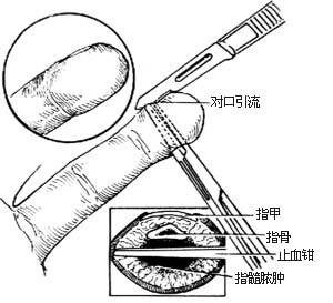 脓性指头炎切开引流术