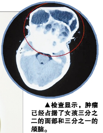 22岁女孩颅脑长巨瘤 面部畸形像“阿凡达”