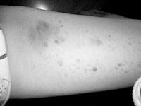 女子按摩瘦腿满腿淤青 抱怨是花钱找打