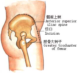 先天性髋关节脱位的手术