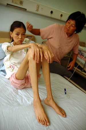 全球最恐怖的67种怪病
