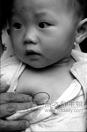 10个月大女婴胸中检查出钢针