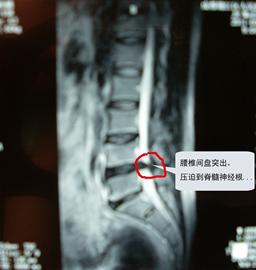 30岁成“瘸子” 颈腰椎病惹的祸