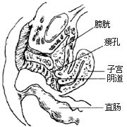 膀胱阴道瘘修补术