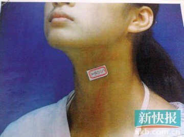 少女整容被毁容医院不愿担责 法官调解赔付10万