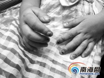 5岁女孩寄养1月遭虐待致双手骨折全身牙印