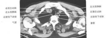 正常胸部纵隔窗CT（1）