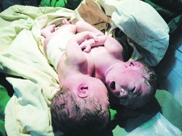 孕妇剖腹产下连体男婴 丈夫干过多年油漆工