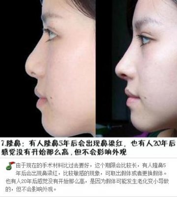 整形手术保质期大揭秘