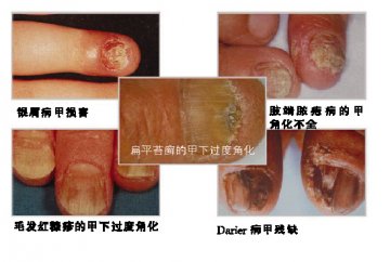 甲真菌抬头 治疗快准狠