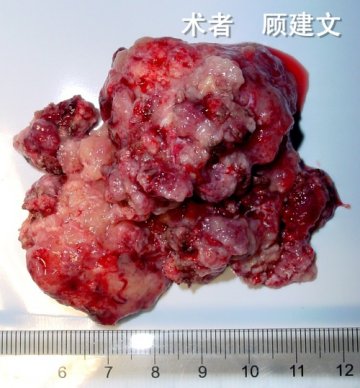 嗅沟脑膜瘤致精神症状
