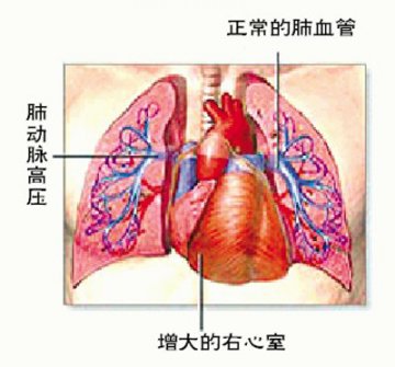 肺栓塞手术 不仅仅为了取栓子
