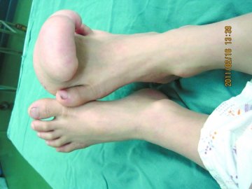 切除拳头大的脂肪瘤 5岁男孩不再