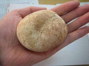 老汉从膀胱里取出鸭蛋大结石治好肾虚